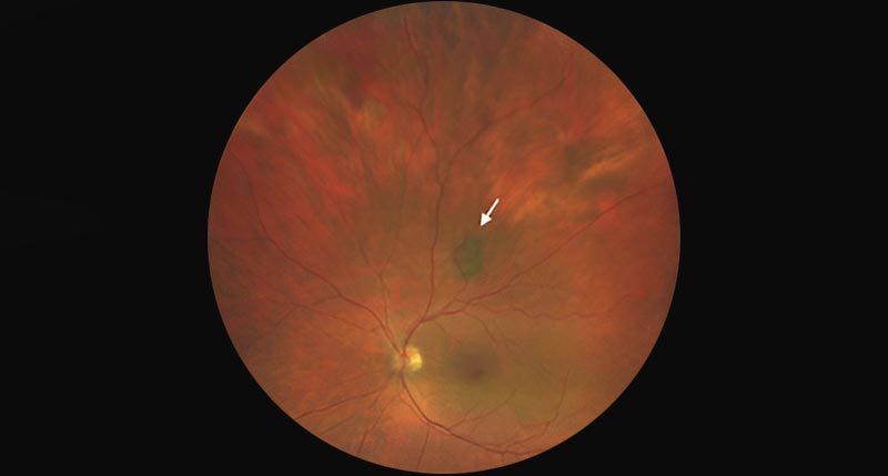 When a Freckle in the Eye Isn’t Just a Freckle